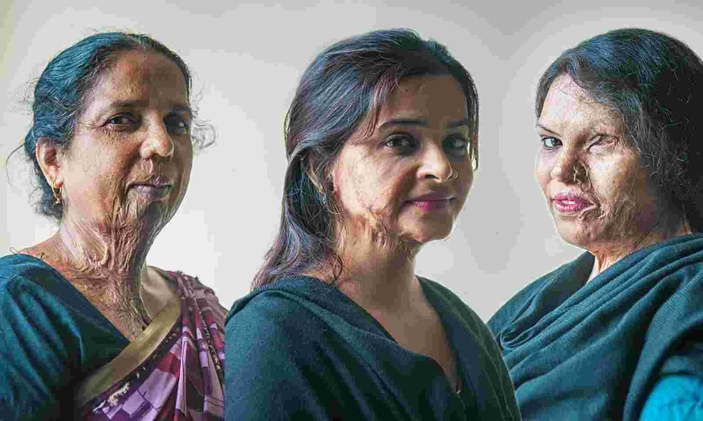Acid Attack Survivor Denied Treatment: HC on Providing Free Treatment 1 1600x960_155770-218f3d886776983eb8795e5298c09a58